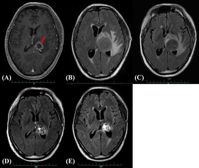 Zanubrutinib Treatment of Central Nervous System Posttransplant Lymphoproliferative Disorder After Allogeneic Hematopoietic Stem Cell Transplantation: A Case Report